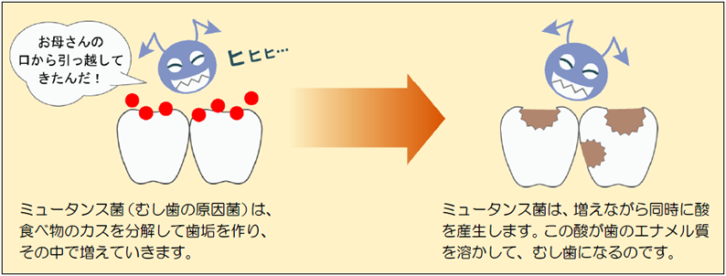 むし歯の原因菌であるミュータンス菌がむし歯を作るメカニズム
