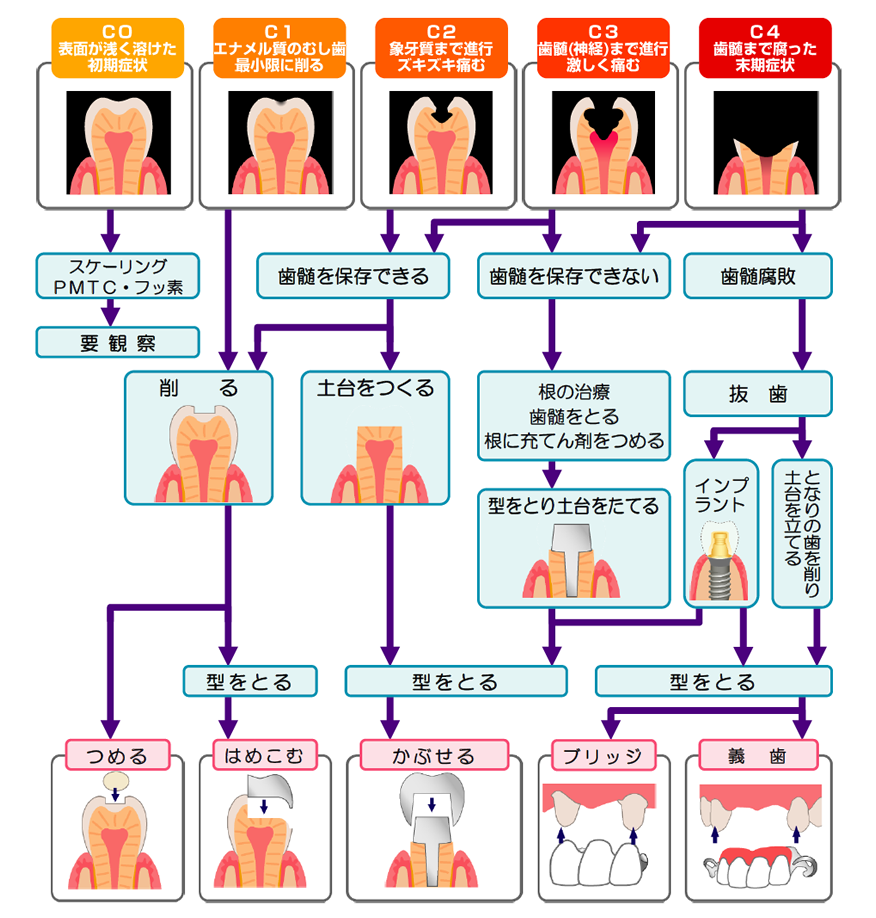 おおまかなむし歯の診断とその後の処置フロー