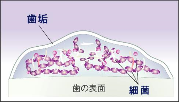 歯周病